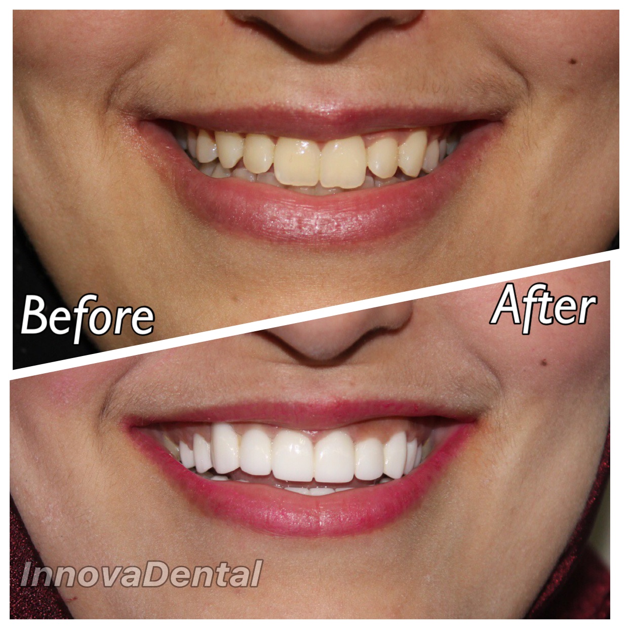 Before Image - Our Invisalign Patients Love Smiling