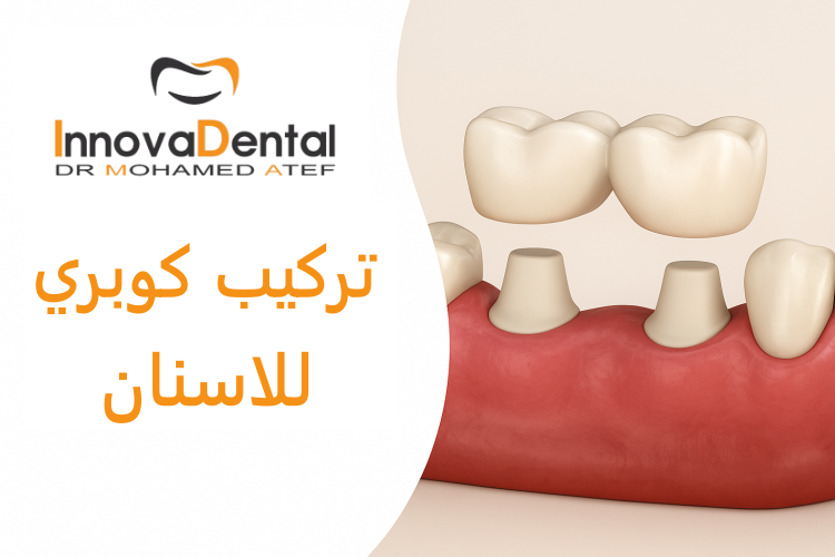 Dental bridge placement: the ideal solution for replacing missing teeth ...