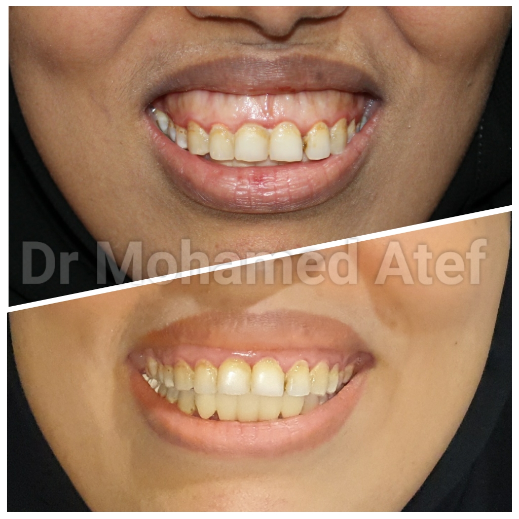 Gum treatment