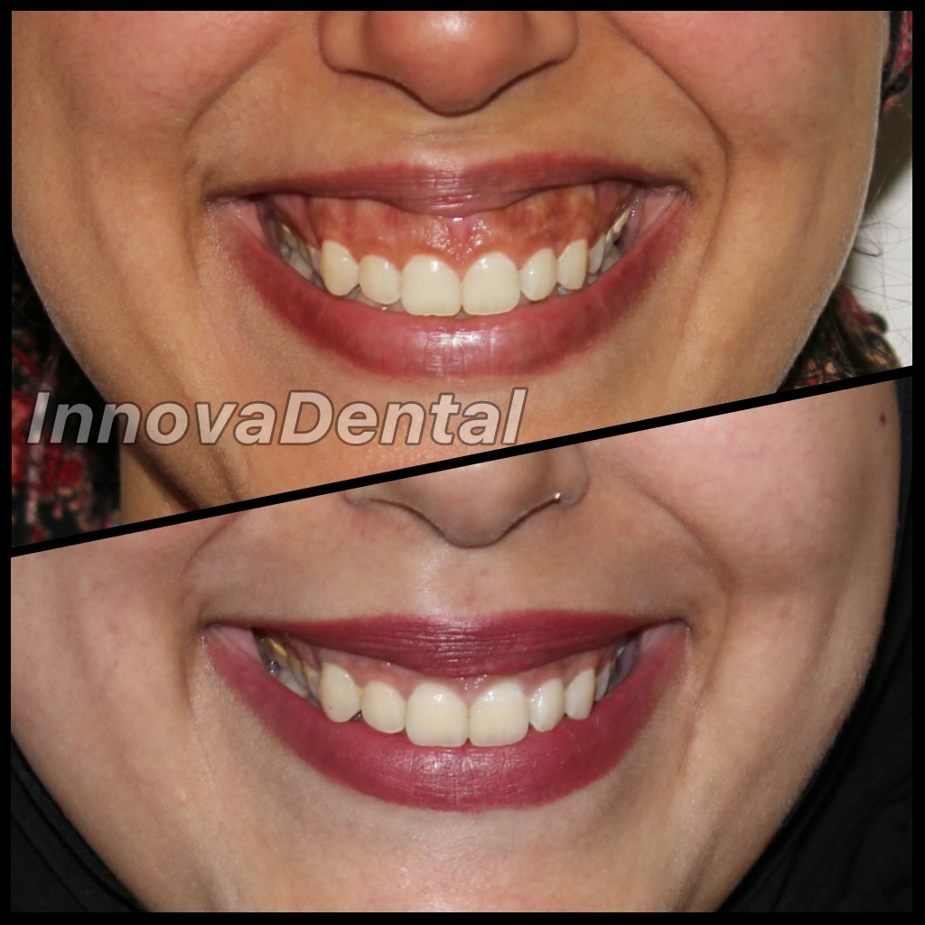 Gum treatment