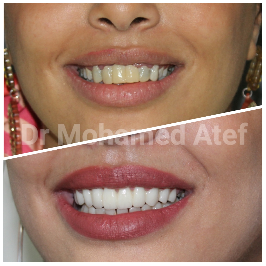 Hollywood Smile